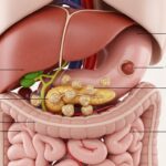 Understanding Cholerhiasis: Causes, Symptoms, Treatment, and Practical Management
